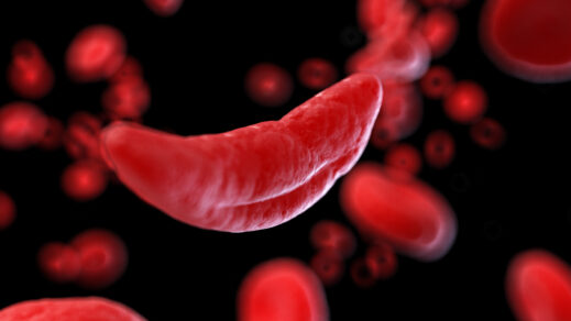 New York City Council Passes Bill to Raise Awareness of Sickle Cell Disease and Make Testing More Accessible