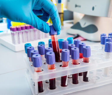 A lab technician's gloved hand placing vials with blood in a test tube holder.